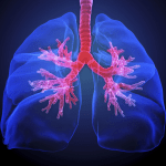 Lungs with cystic fibrosis