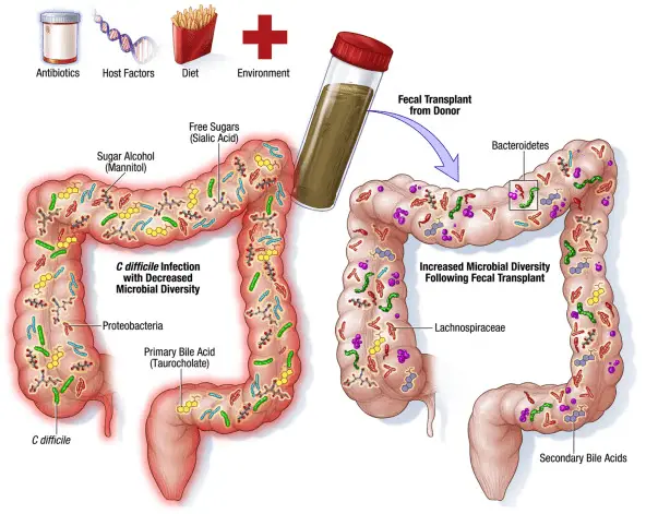 Fecal microbiota transplantation