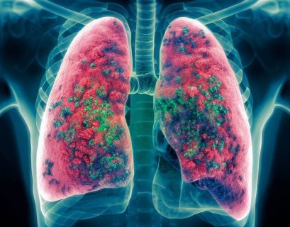 Bacterial infection in lungs treated with phage therapy