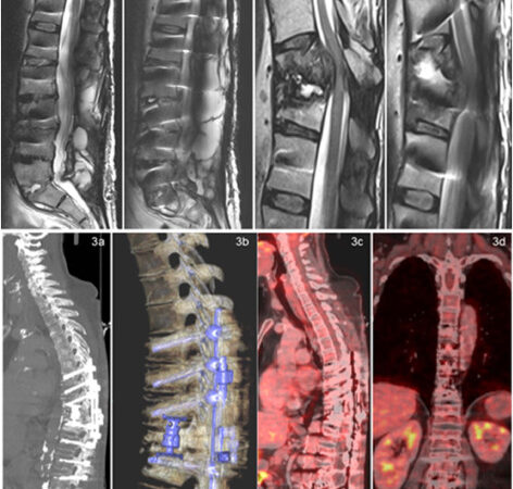 Image showing MRI with spondylodiscitis