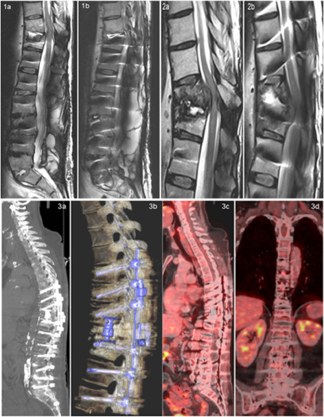 Image showing MRI with spondylodiscitis